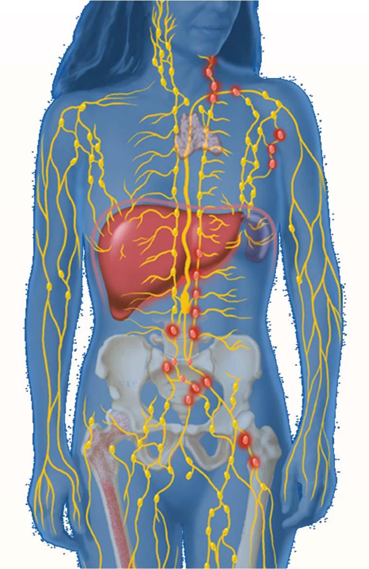 Ann Arbor Staging System Stage I Single lymph node group Stage II Multiple lymph nodes on same side of diaphragm Stage III Multiple lymph nodes on both sides of