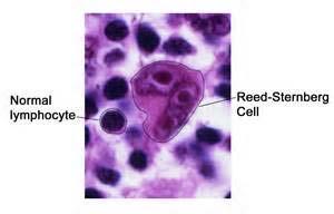 Hodgkin s Disease Clonal lymphoid