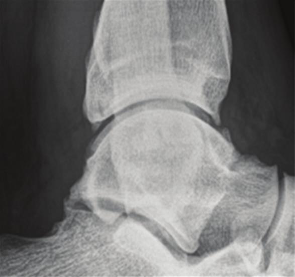 Dorsal and plantar flexion were only slightly reduced compared to the left ankle.