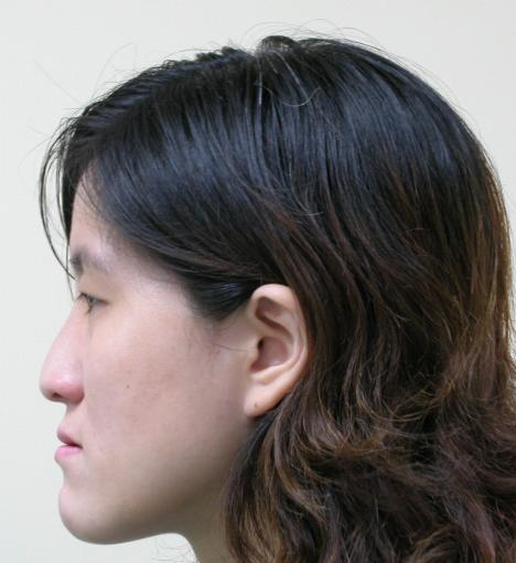Her lateral profile was concave, and the frontal view showed facial asymmetry phenomenon (Figure 1).