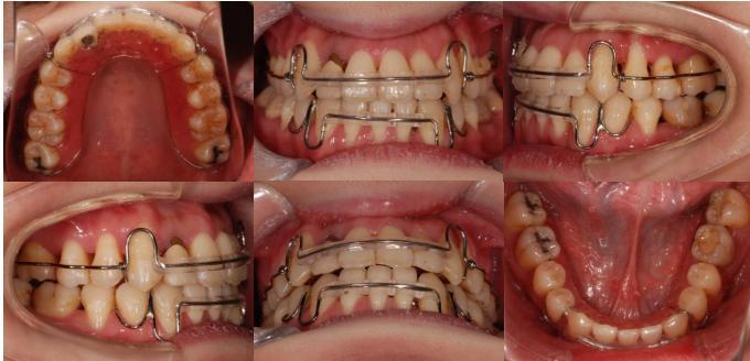 Therefore, adult anterior crossbite with severe crowding combined facial asymmetry and full mouth periodontitis can be well treated with differential ISW MEAW technique.