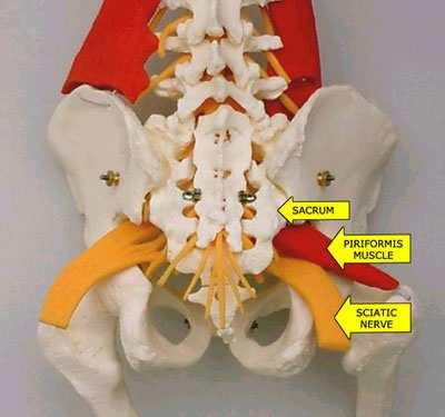 Piriformis Piriformis Syndrome causes compression and irritation of the sciatic nerve in the buttock, and is a cause of buttock pain and sciatica outside the spine.
