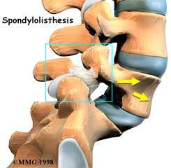may be associated with sciatic pain particularly after standing or walking for prolonged periods, due to settlement in the spine decreasing the diameter of the foramen.