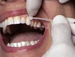 Placement of Anchorage Ties 1 Select a tooth in each quadrant with contact points medially