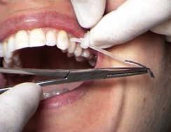 interdental space on the medial side of the tooth.