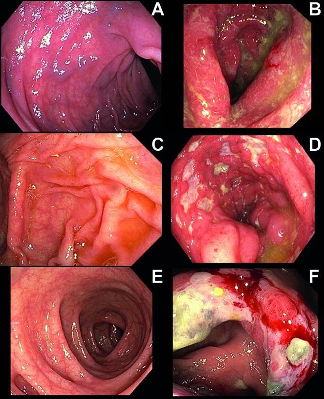 ENDOSCOPIC APPEARANCES OF COLITIS 42 (68%) had a pancolitis ( 3 affected segments). Ulcers were seen in 32% of endoscopies.
