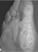 reactions on the hands and feet are the same Periarticular thenar erythema and onycholysis (PATEO) Dorsal hand foot syndrome Taxanes Hand foot syndrome Palmoplantar erythrodysesthesia Acral erythema