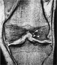 meniscus meniscal tear (arrow) intercondylar erosions (arrowheads) 25