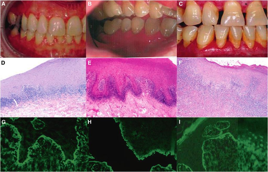 Direct Immunofluorescence and Diagnosis of Desquamative Gingivitis Volume 83 Number 10 Figure 1. A, B, and C) Similar clinical presentations of three cases with generalized DG.