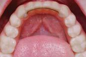 2) RPEs can reduce buccal bone plate thickness and the buccal alveolar
