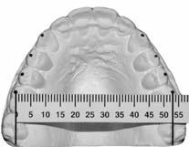 Upper 1st Bicuspids The mandibular inter-cuspid distance was maintained