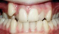 stimulate tooth movement without cutting off the vascular supply to the