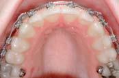 gingival recession 4 as well as significant expansion relapses.
