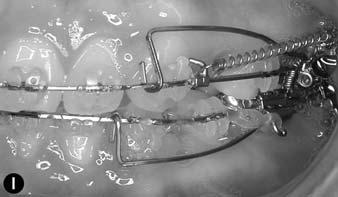 A, Right buccal photograph of extraction mechanics
