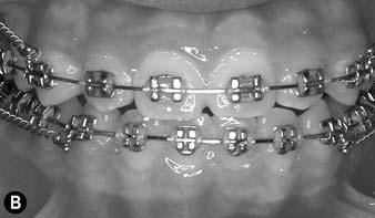 For maximal counterclockwise rotation, both the maxillary and mandibular posterior teeth should be intruded. 4.