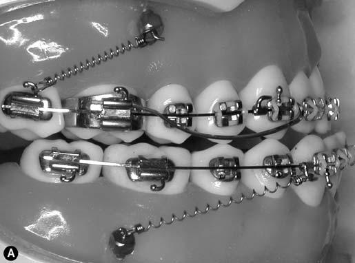 Chapter 15 - The LOMAS System 229 stainless steel with anterior facial root torque to prevent facial tipping of the anterior teeth. The mandibular arch wire should be 0.016 0.