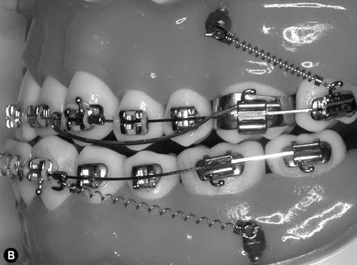 Bilateral heavy-force NiTi CCSs are attached from the LOMAS miniscrews to the hooks of the maxillary second molars for en masse protraction.