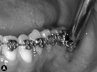 A 32CNA-TPA with mesial angulation and lingual crown torque is inserted into the lingual sheaths on the molars.