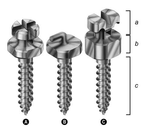 214 Section 4 - MiniScrew Implant Systems Threaded Body The threaded body has a sharp cutting tip for self-drilling, a tapered shape for self-tapping, and deeper thread depth for better mechanical