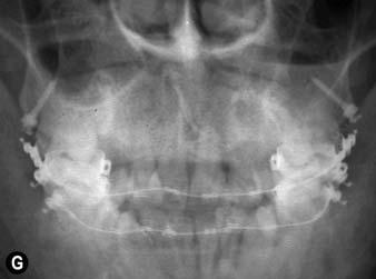 The thickness of the infrazygomatic crest and floor of the maxillary sinus is evaluated on the posteroanterior cephalometric and