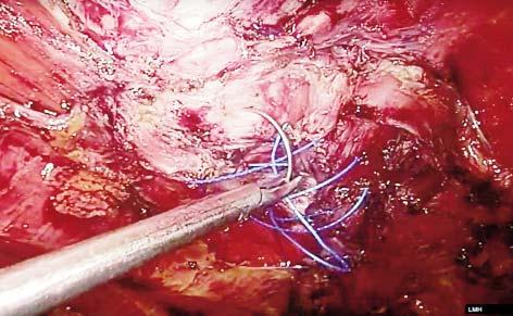Retromuscular Approach in Ventral Hernia Repair - Endoscopic Rives-Stoppa Procedure Figure 6. Restoration of the linea alba Figure 7.