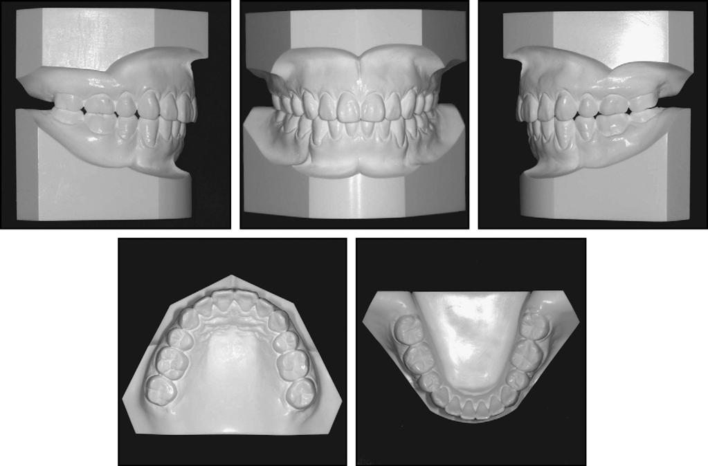 Kuroda et al 361 Fig 10. Five-year postretention dental casts. Fig 11.