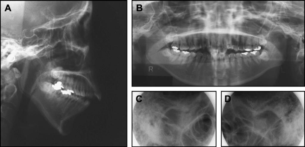 354 Kuroda et al Fig 2. Pretreatment dental casts. Fig 3. Pretreatment radiographs: A, lateral cephalogram; B, panoramic radiograph; C and D, transcranial radiograph of TMJ (C, right; D, left).