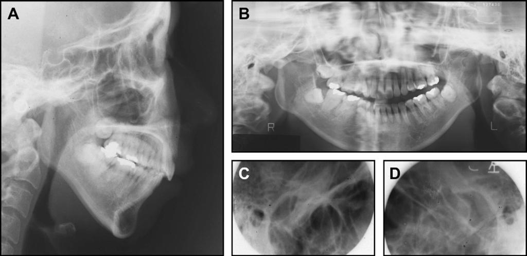 358 Kuroda et al Fig 6. Posttreatment dental casts. Fig 7. Posttreatment radiographs: A, lateral cephalogram; B, panoramic radiograph; C and D, transcranial radiograph of TMJ (C, right; D, left).
