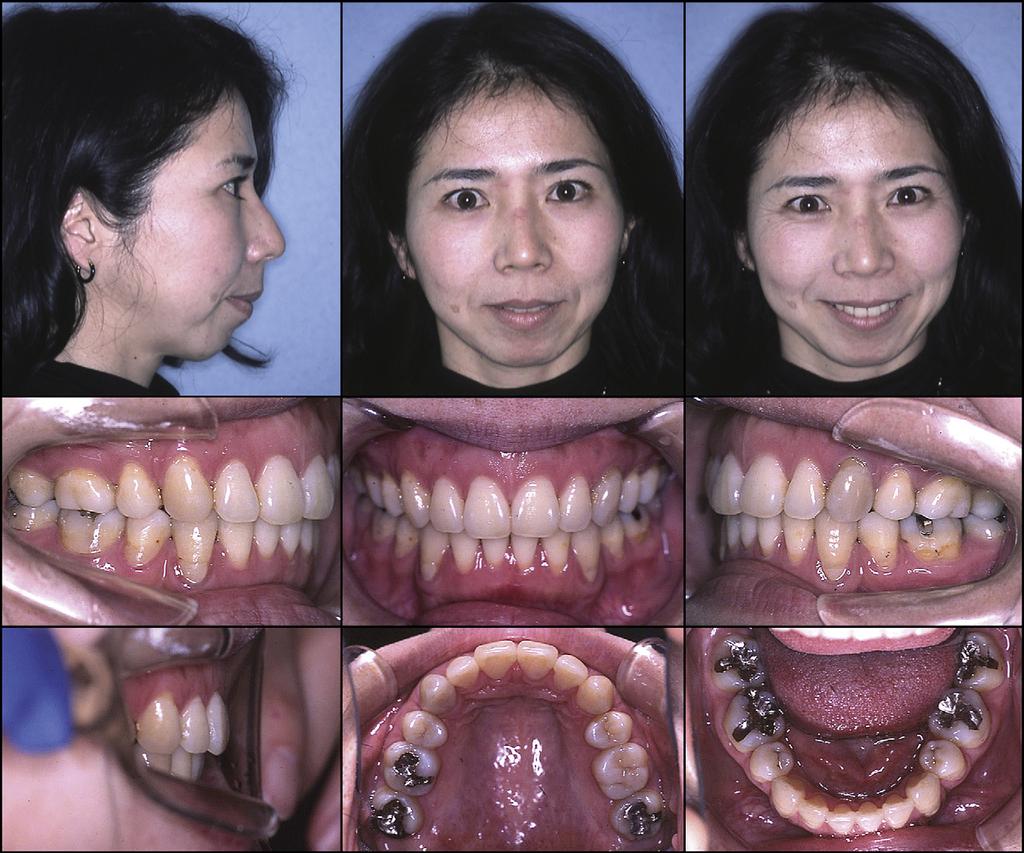 360 Kuroda et al Fig 9. Five-year postretention facial and intraoral photographs. The posttreatment radiographs showed that condylar resorption did not worsen during and after orthodontic treatment.