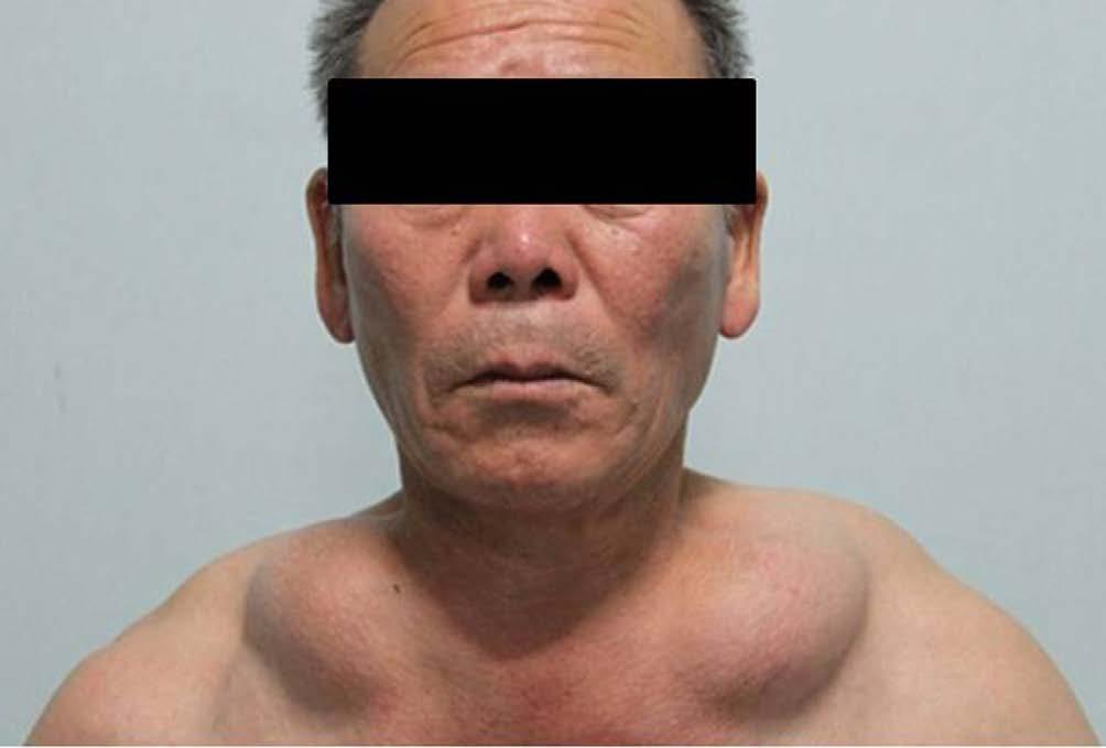 . Fig. 1. A photograph of a 64-year-old man, showing large, symmetrical, protruding mass lesions at the anterior aspects of the bilateral supraclavicular areas. a b Fig.