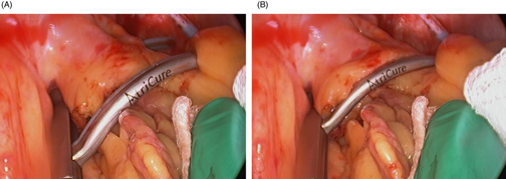106 Surgical Treatment of Atrial Fibrillation FIGURE 5.17 (A) Bipolar clamp passing with ease around the left antrum. (B) Clamp closed and ready to fire.