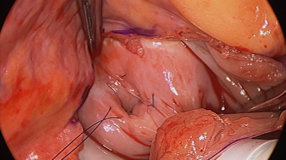 Mastering the Initial Dissection and Cannulation: Making Ablation Easy and Safe Chapter 5 111 of CS with forceps brings it into very good control and
