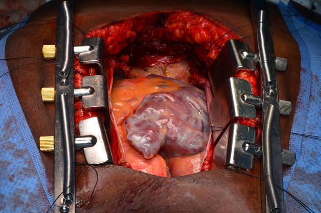 Here the SVC is elevated and connecting tissue between it and the pulmonary artery is dissected from both sides of the SVC until it has a wide passage underneath which will typically be large enough