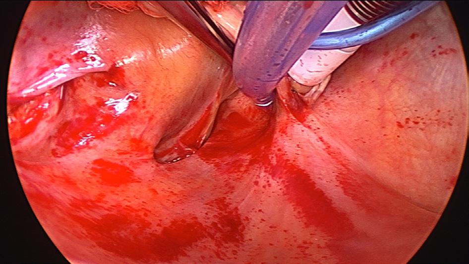 6 OPEN THE OBLIQUE SINUS SUPERIORLY OVER THE LA DOME AND TAKE DOWN THE SUPERIOR PERICARDIAL REFLECTIONS This is the one that scares learning surgeons but don t let it.