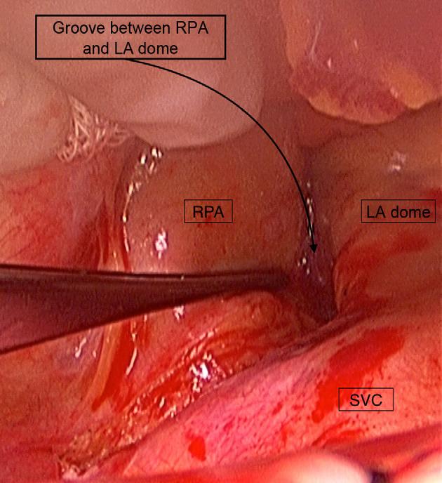 This is the working exposure needed to dissect the dome of the LA from its attachments to the RPA and the superior pericardium. FIGURE 5.