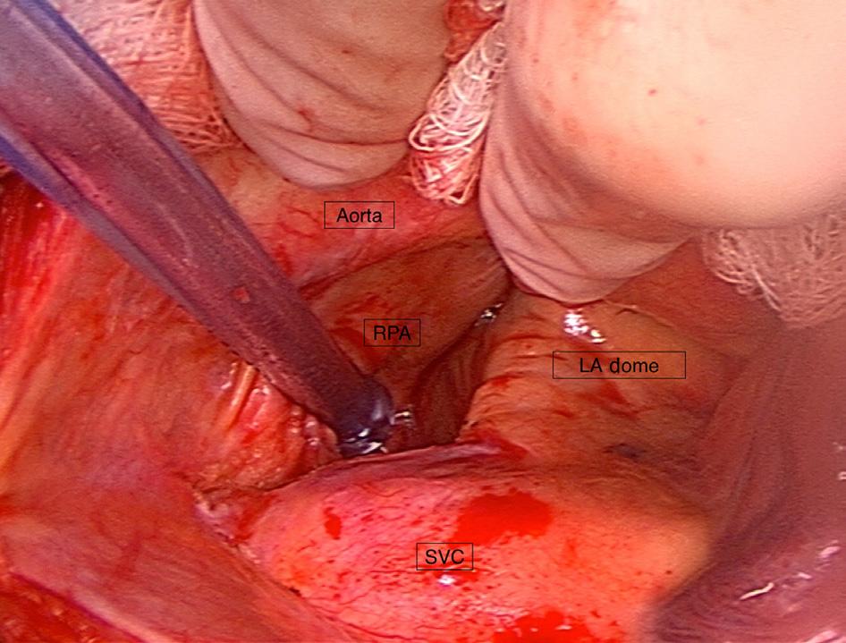 102 Surgical Treatment of Atrial Fibrillation FIGURE 5.9 RPA retracted superiorly as the plane deepens down over the LA toward the oblique sinus below. FIGURE 5.10 Close-up of the dome dissection view showing initial entry into the oblique sinus below.