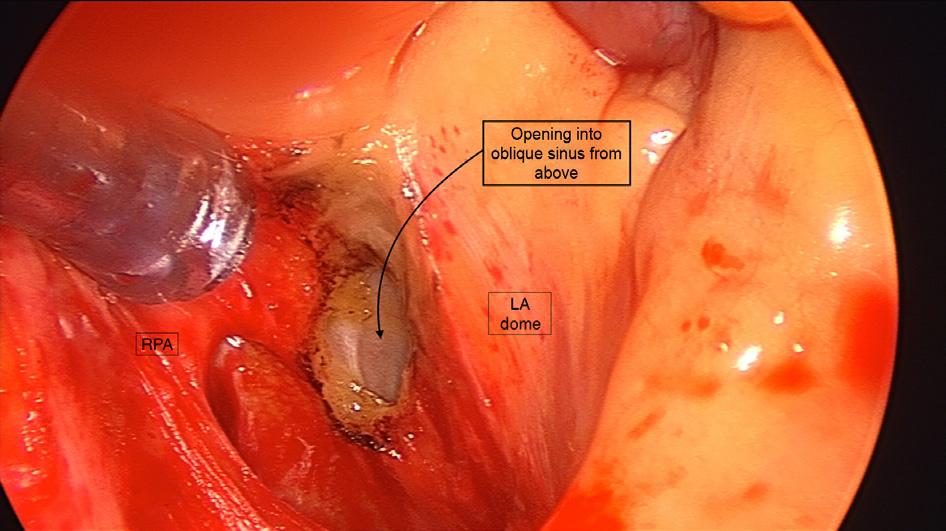 Mastering the Initial Dissection and Cannulation: Making Ablation Easy and Safe Chapter 5 103 FIGURE 5.