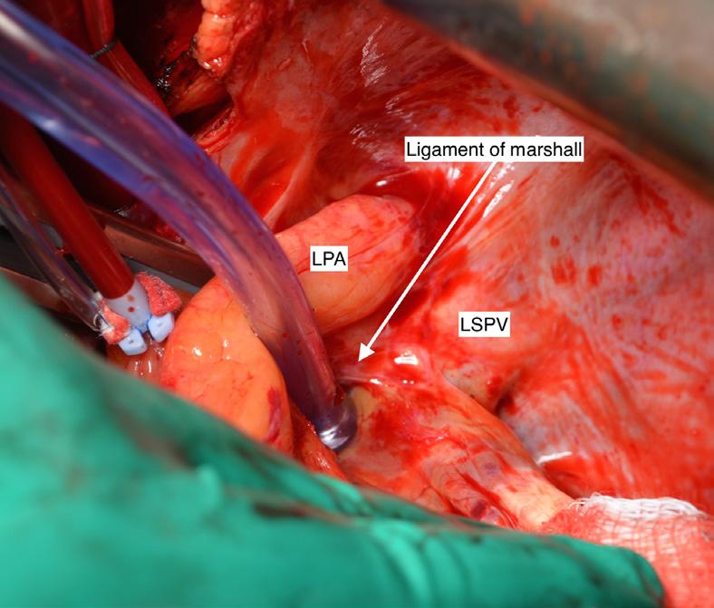 14 we have now changed sides and have retracted the heart hard over to the right putting the left pulmonary veins on tension and we are retracting the LPA superiorly.