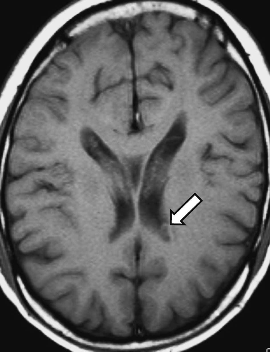 A 37-year-old man with Tolosa- Hunt syndrome. Axial T 1 -weighted image (T 1 WI) at the level of the roof of the body shows a left ringshaped lateral ventricular nodule (RSLVN, arrow).