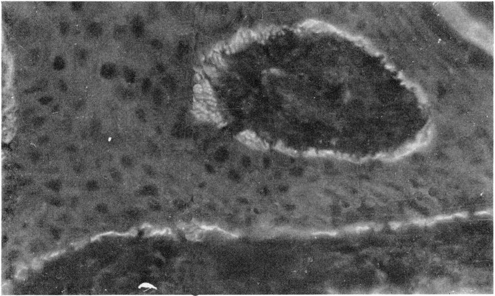 pemphigoid. Dermis at bottom. Circle is immunofluorcscence of basement membrane surrounding a dermal papilla (cut horizontally). tients with pemphigus.