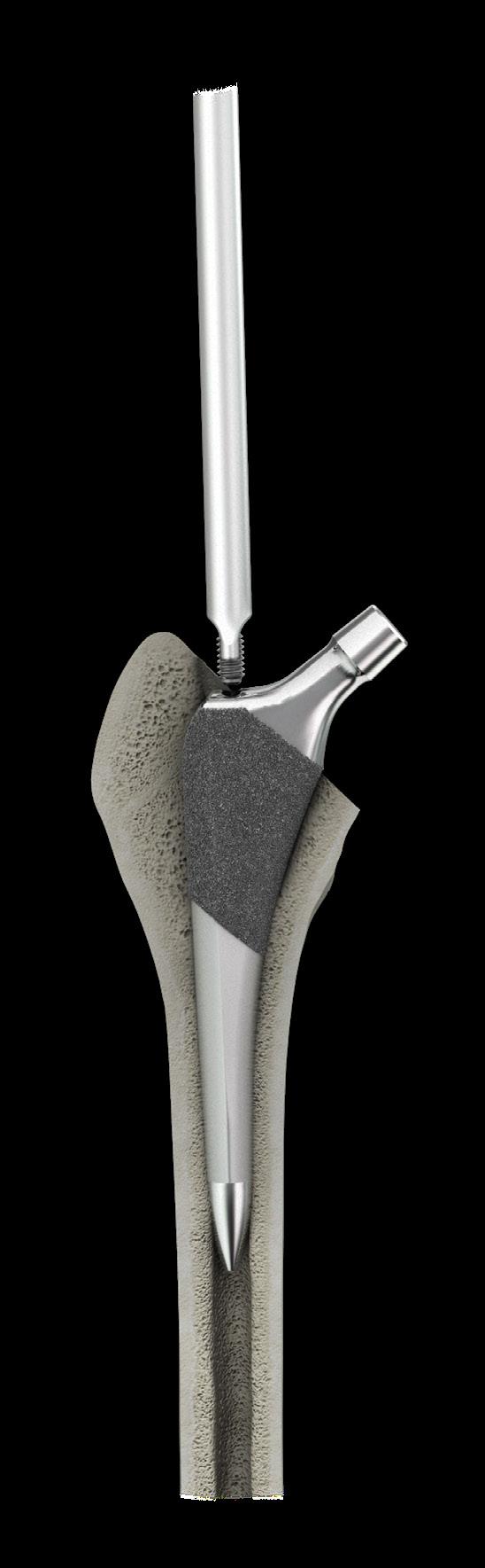 Figure 11a: Optional Threaded Figure 11: Stem Insertion Figure 12: Femoral Preparation 7. Femoral Component Insertion Select the Alpine Cementless Implant that corresponds to the final Broach.