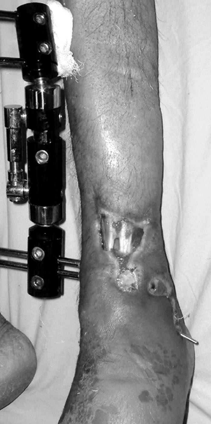 2220 tients were assessed for local skin condition, shortening, deformity, distal neurovascular status, and joint function.