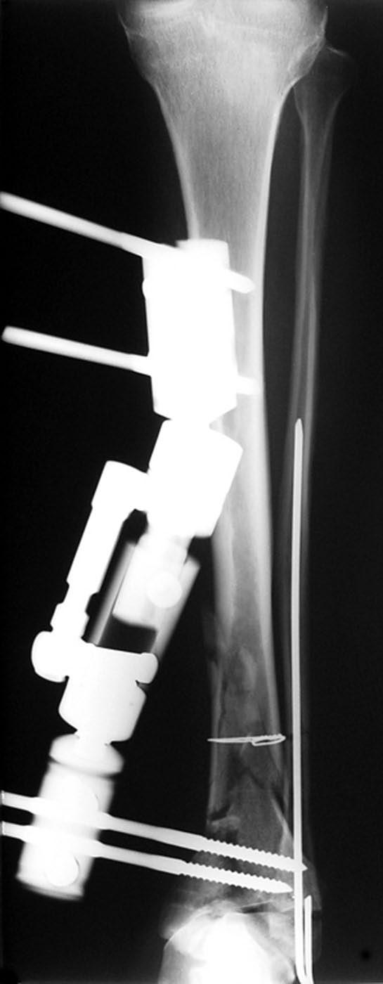 The complications were evaluated according to the criteria described by Paley 19. Operative Technique The operative procedure for osteomyelitis was done in two stages as described by Kocaoglu et al.