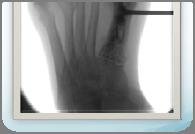 significant loss of bone integrity Indications in Chronic Osteomyelitis