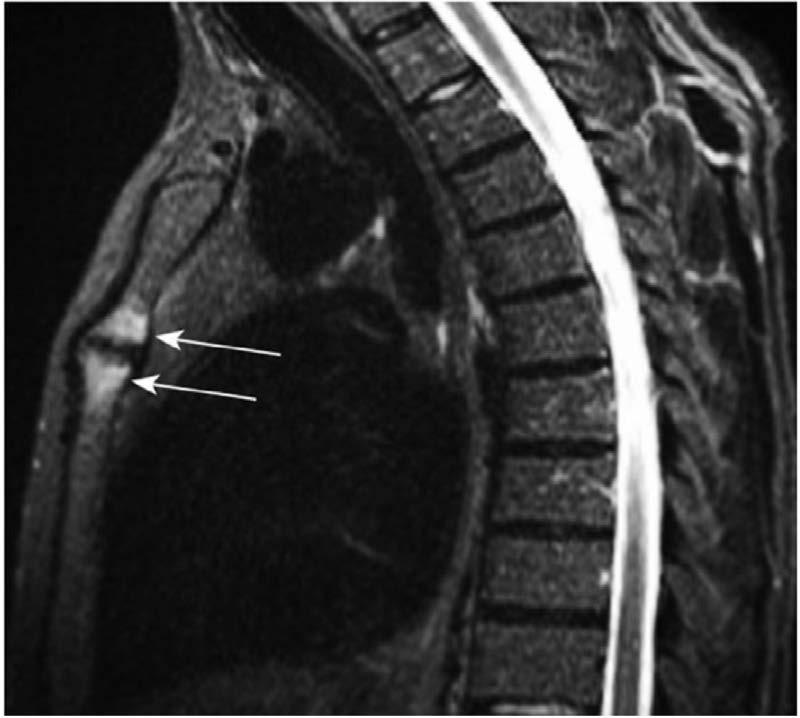Inflammatory lesions of the anterior chest wall displayed by whole-body MRI in an ankylosing spondylitis patient