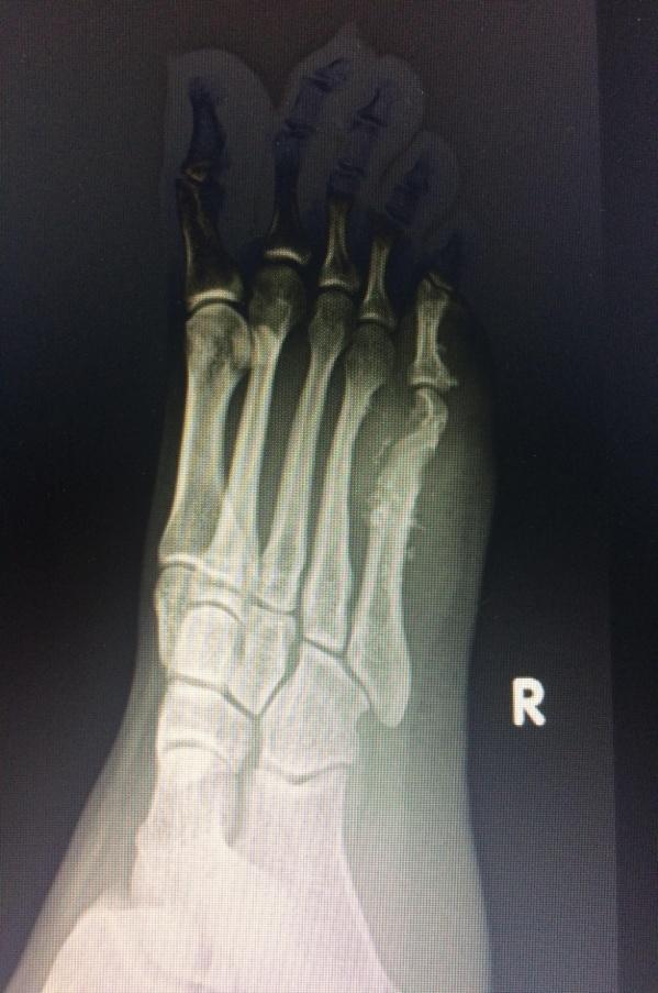 Figure 3: Xray of the right foot AP and oblique showing an erosive lesion, with punctate calcifications in the 5th Metatarsal diaphysis with a significant soft tissue component in the 4th web space