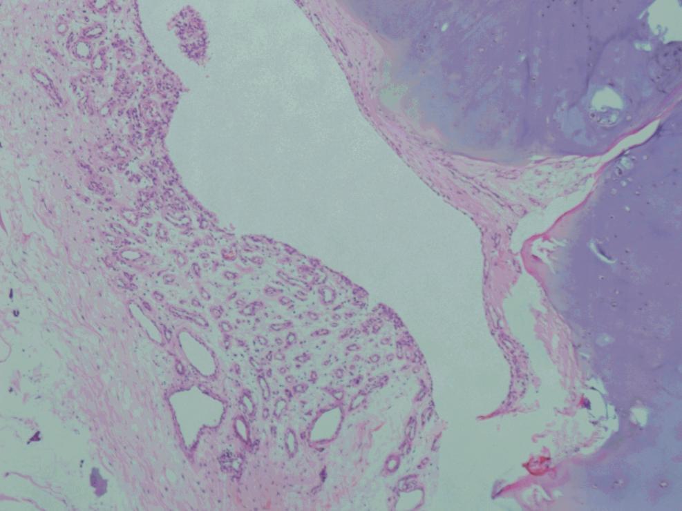 The Excision Biopsy report showed a cartilaginous neoplasm composed of chondrocytes arranged in lobular pattern.