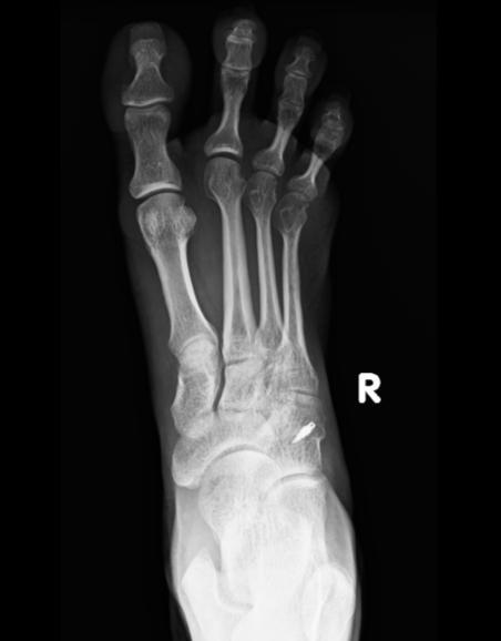 Figure 11 Xray right foot AP, lat at 2 year follow up II.