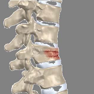 OsseoFix - Improved VCF Solution Providing a better solution for patients with vertebral compression