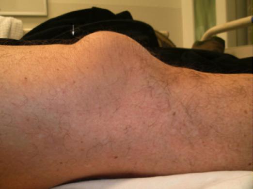 Q5: Why is it important to maintain a high index of suspicion for occult knee dislocation in this case, and what tests would you order to confirm the diagnosis?